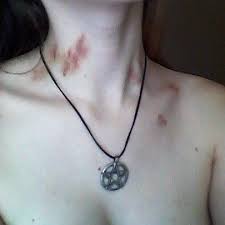 Rintyeryeѕt Maryvirmoux Hickeys Dark Aesthetic Hickies