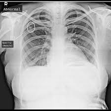 Tuberculosis, a disease that used to be common in the uk and other western countries, was the doctor who examined mr abas suspected lung disease. These Algorithms Could End The Scourge Of Tuberculosis The New York Times