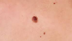 Hormonal changes of adolescence and pregnancy may cause moles to become darker and larger. Can Home Remedies Get Rid Of Moles 14 Ways