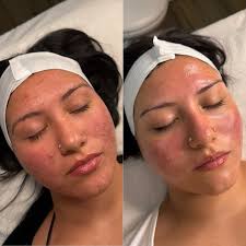 before and after 3 months of consistent treatments and a custom regimen  designed by me This angel and her parents came to me in early May, fully  trusting me to help heal