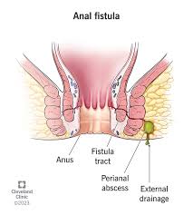Image result for Perianal Abscess
