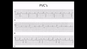 This test records the electrical activity of. Easy Ekg Premature Ventricular Contractions And Atrial Fibrillation Youtube