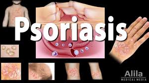Skin cancer is by far the most common type of cancer. Psoriasis Types Symptoms Causes Pathology And Treatment Animation Youtube