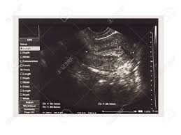 Pelvic ultrasound in the postabortion and postpartum patient. Ultrasound Imaging Of Female Uterus Isolated On White Background Medical Pelvic Sonography Scan Stock Photo Picture And Royalty Free Image Image 126961344
