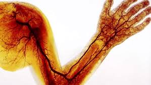 Damar Tikanikligi Nedir Damar Tikanikligi Neden Olusur Ve Belirtileri Nelerdir