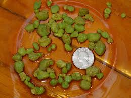 Pin On Liver Gall Stones
