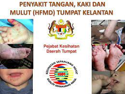 Tapi orang dewasa bisa tertular. Ppt Penyakit Tangan Kaki Dan Mulut Hfmd Tumpat Kelantan Powerpoint Presentation Id 4198157