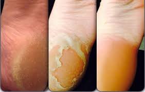 After all, your skin goes through a natural exfoliation process the feet are dipped a few more times to form a thick wax layer, before being allowed to dry for 10 to 15 minutes. Everyone S Raving About Baby Foot For Calluses But Is It Safe Women S Health