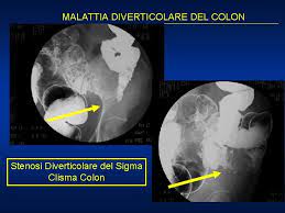 La patologia per la quale papa francesco sarà operato al policlinico gemelli di roma è una conseguenza della diverticolite. Malattia Diverticolare Del Colon I Diverticoli Del Colon