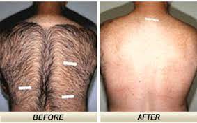 Laser hair elimination works by warming the hair roots to stop new hairs from growing. The Pros And Cons Of Laser Hair Removal