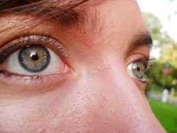 Heterochromia is determined by the production, delivery, and concentration of melanin (a pigment). Central Heterochromia Rare Eye Colors Eye Color Beautiful Eyes