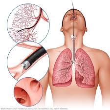 Has a stroke every 40 seconds. Lung Cancer Diagnosis And Treatment Mayo Clinic