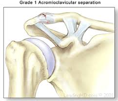 A grade 2 sprain refers to a ligament that has been stretched and a partial tear could be present. Ac Separation
