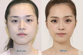 31 Crazy Before And After Photos Of Korean Plastic Surgery Korean Plastic Surgery South Korean Plastic Surgery Plastic Surgery Pictures