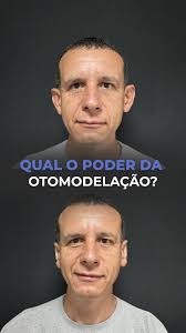 Orelha de abano realmente muda a aparência? Olha essa análise aqui do  jogador Gareth Bale.