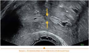 Nabil moulay.adenomyosis.hysteroscopy gynecologue rabat maroc.hysteroscopie. Reconnaitre Une Synechie Uterine En Echographie C Est Possible Revue Genesis