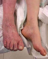 Compgefa Thrombose Phlebothrombose