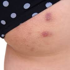 Mar 12, 2021 · eat a good amount of fish every week to ingest omega 3 which will in turn help you fight against your sweat pimples. What Causes Butt Pimples
