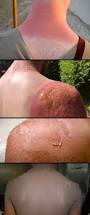 Image result for Sunburn