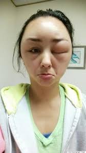 The severity of the reaction is compared to a scale and recorded as 1+ or 2+. Shocking Photos Show Woman S Ballooning Face After Allergic Reaction To Hair Dye Huffpost Uk Life