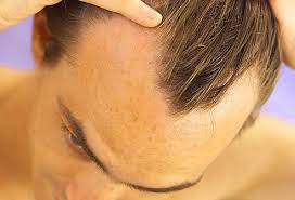 Most conditions that cause scalp inflammation can be treated using a combination of personal care products and/or medications. Hair Loss Treatments Symptoms Causes Prevention