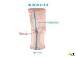 Pain Behind Knee Why It Hurts In Back Of Or Under Your Kneecap