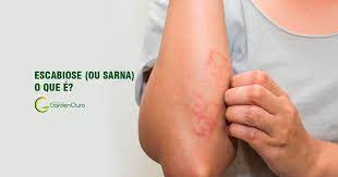 Scabies is a skin condition caused by small mites living in your skin, leading to a scaly red rash and itching. Escabiose Ou Sarna O Que E Clinica Medica Curitiba