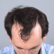 The cut is short which adds volume and the front flip helps create a unique look that adds a flair which is very appealing. Thinning Hair Archives Skalp