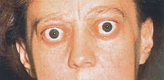 The commonest cause is an immunological disorder associated with the thyroid gland, but exophthalmos, or proptosis, may be caused by tumour, bleeding or a mucous cyst from a sinus (mucocoele). Exophthalmus Endokriner Gesundheit De
