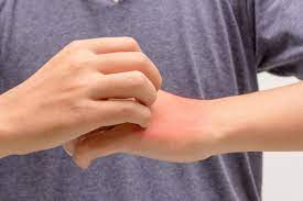 Obat ini dapat dibeli tanpa resep dokter, tapi bunda bisa bertanya dulu pada ahlinya agar. 6 Penyebab Telapak Tangan Gatal Dan Terasa Panas