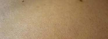Keratinocyte cancer is more common in men, with almost double the incidence compared to women. Which Type Of Skin Cancer Is The Most Dangerous