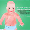Evaluate for >10% atypical lymphocyte s. 1