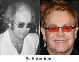 Did Elton John Have A Hair Transplant Hair Transplant Elton John Celebrity Hairstyles