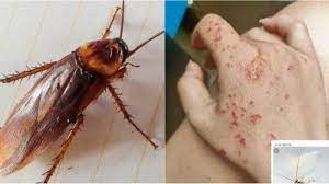 We did not find results for: Tangan Wanita Ini Digigit Kecoak Saat Tidur Karena Tak Cuci Tangan Dengan Bersih Halaman All Tribun Medan