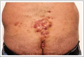 Pilonidal sinuses result from skin and subcutaneous tissue infections, typically occurring at or near the upper part of the natal cleft of the buttocks. Editor S Choice 2019 British Journal Of Dermatology Wiley Online Library