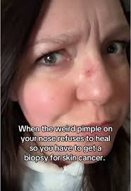 Image result for skin cancer on nose pimple