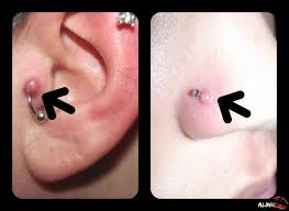Things That Go Bump On Your Piercing Nose Piercing Bump Skin Piercing Piercing Bump