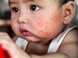 Maybe you would like to learn more about one of these? Kenali Ruam Merah Pada Wajah Si Kecil Spesialis Klikdokter Com
