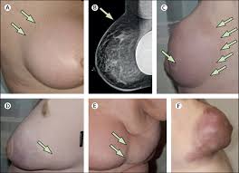 If you've received a diagnosis, here are some things you need to know about the condition. Inflammatory Breast Cancer Unique Biological And Therapeutic Considerations The Lancet Oncology