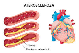 Citochine, factori de creştere, diverse. Arterioscleroza Si Ateroscleroza Simptome Cauze Complicatii Diagnostic Si Tratament Reginamaria Ro