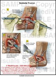 Image Gallery Foot Health Ankle Surgery Medical Conditions
