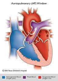 Aortopulmonary Window | Pediatric Echocardiography