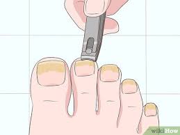 Some signs of it are inflammation, swelling, yellowing, and thickening or crumbling of the. 3 Ways To Treat Toe Nail Fungus Wikihow