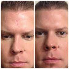 Pin On Before And Afters Dermaflage
