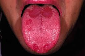 Image result for cancer of tongue