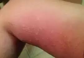 How To Treat Rashes On My Inner Thigh Area Quora