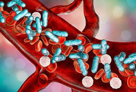 Severe sepsis is an infectious disease state associated with multiple organ dysfunction syndrome (mods) Sepsis Septicemia Definition Treatment Causes Stages Diagnosis