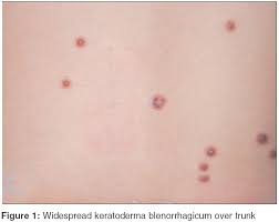 Reiter syndrome is a type of reactive arthritis that happens as a reaction to a bacterial infection in the body. Indian Journal Of Dermatology Venereology And Leprology Reiter S Disease In A Six Year Old Girl
