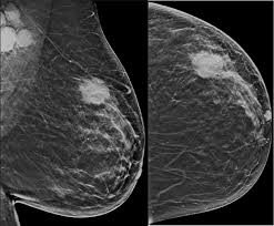 Your best bet is to make yourself aware of the signs and symptoms, some of which are less talked. Breast Imaging And Careers National Breast Imaging Academy