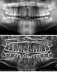 Maybe you would like to learn more about one of these? Pdf An Image Processing Approach Based On Gnu Image Manipulation Program Gimp To The Panoramic Radiography Semantic Scholar
